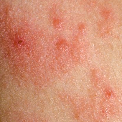 Pityriasis Rosea Stages Symptoms And Complications