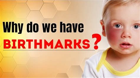 Why Do We Have Birthmarks Science Curiosity Letstute By Letstute