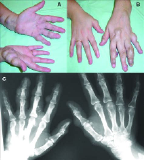 Hands Of A Patient With A Moderate Form Of Maffucci Syndrome