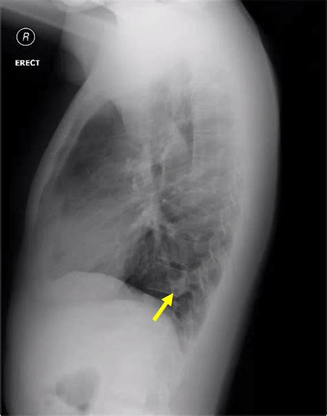 A Chest X Ray Shows A Nodule Arrow In The Left Lower Lung Field Images