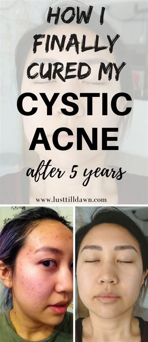 How I Cured My Cystic Acne By Discovering Food Allergies And Acid