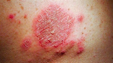 Does Eczema Look Like A Rash