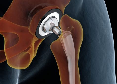 Medically Accurate Illustration Of The Hip Replacement 3d Illustration