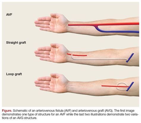 Fistula For Dialysis Placement