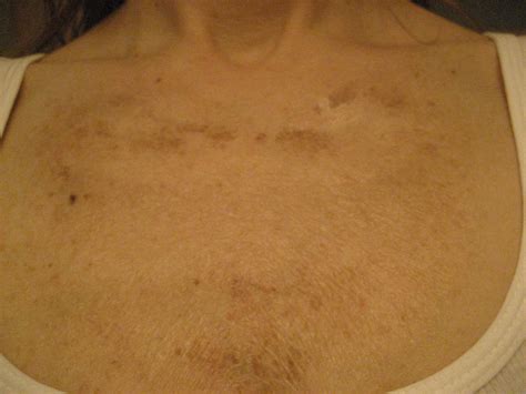 Chemical Peels For Acne And Anti Aging Tca Chest Peel