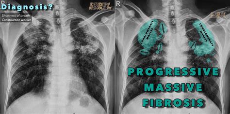 Progressive Massive Fibrosis On Chest X Ray In A Construction Grepmed