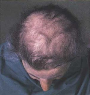 I was wondering what vegan mayo you recommend? Milk: Hair Loss - Soy To Treat Hair Loss