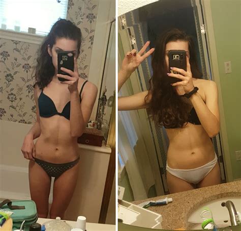 Before After Pics Of People Who Defeated Anorexia Bored Panda