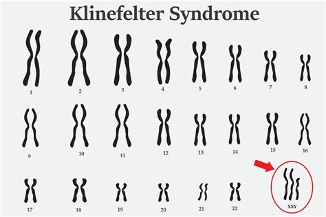 Cosè La Sindrome Di Klinefelter Plus Magazine