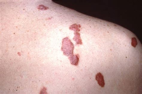 Pictures Of Skin Cancer Md