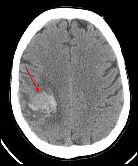 Brain Lesions Causes Brain Lesions Diagnosis And Brain Lesions Treatment