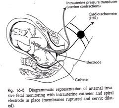 Electronic Fetal Monitoring flashcards | Quizlet