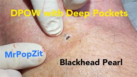 The Blackhead With Deep Pockets Dpow Blackhead Pearl Extraction On