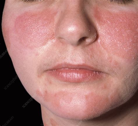 Seborrheic Dermatitis Stock Image C Science Photo Library