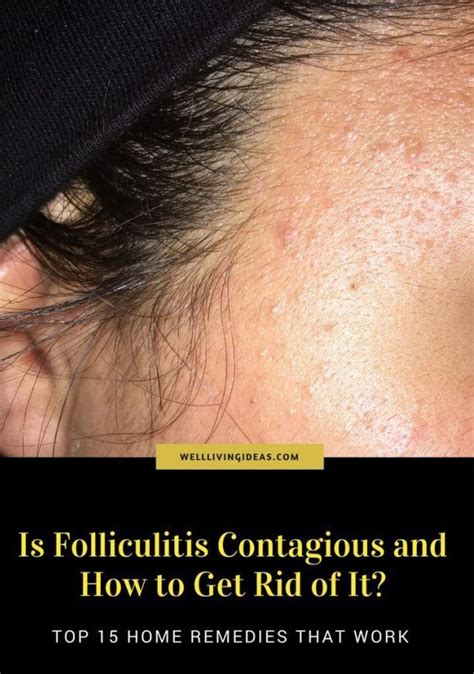 15 Simple Natural Remedies For Folliculitis Cure Natural Home