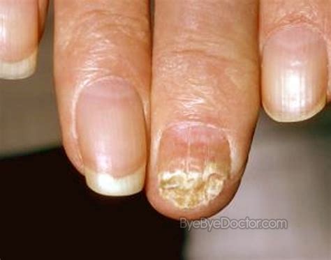 Yeast Infection Fingertips Guide