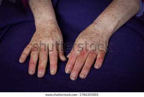Closeup Womans Reddened Hands Wounds Raynauds Stock Photo 1786303001