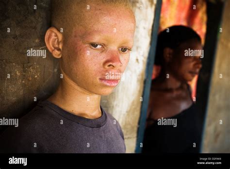 Teenage African Albino Boy Mother Hi Res Stock Photography And Images