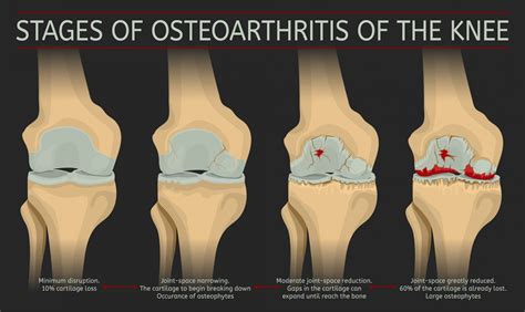 What Is Osteoarthritis Of The Knee Stages Symptoms Causes Diagnosis