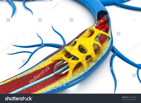 Stent Angioplasty Procedure With Placing A Balloon Stock Photo