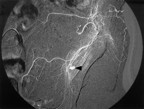 Selective Angiogram Of The Deep Circumflex Iliac Artery Showing A