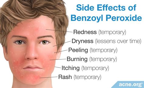 Everything You Need To Know About Benzoyl Peroxide