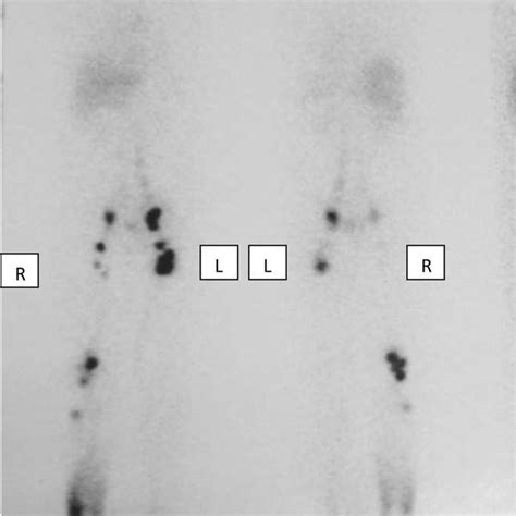 Lymphoscintigraphy Anterior And Posterior Images Of Lower Limb Ll