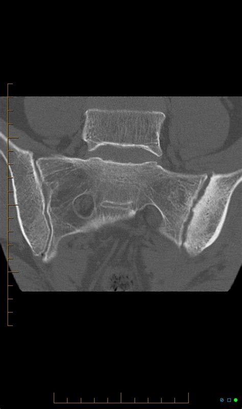 Unilateral Sacroiliitis Image