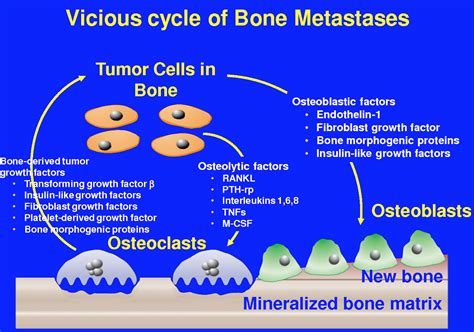 Metastatic prostate cancer is an important clinical problem in terms of the number of men who are affected, its impact on quality of life, and as a cause the management of men with bone metastases from advanced prostate cancer is reviewed here, including treatments to palliate pain and therapies. Pin on Prostate cancer