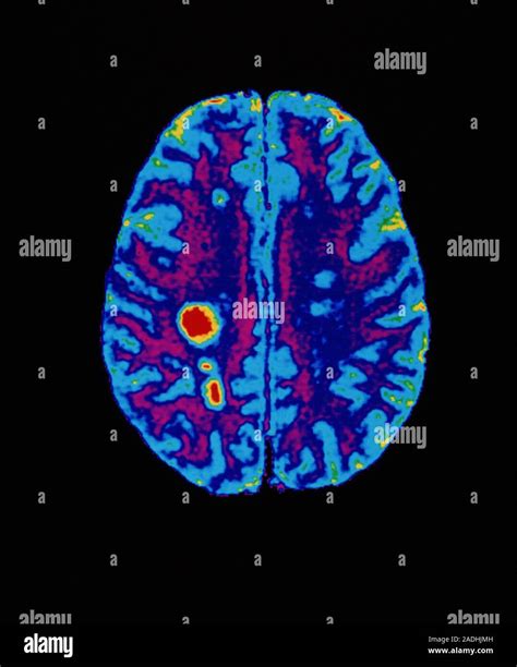 Multiple Sclerosis Coloured Magnetic Resonance Image Mri Scan Of An