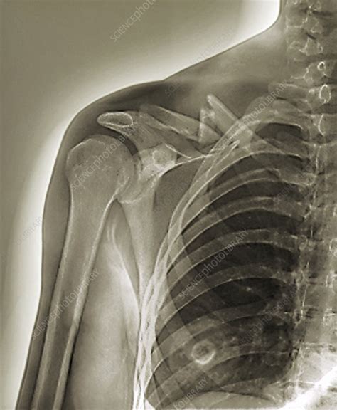 Collar Bone Fracture X Ray Stock Image C0212246 Science Photo