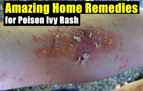Amazing Home Remedies For Poison Ivy Rash Shtfpreparedness