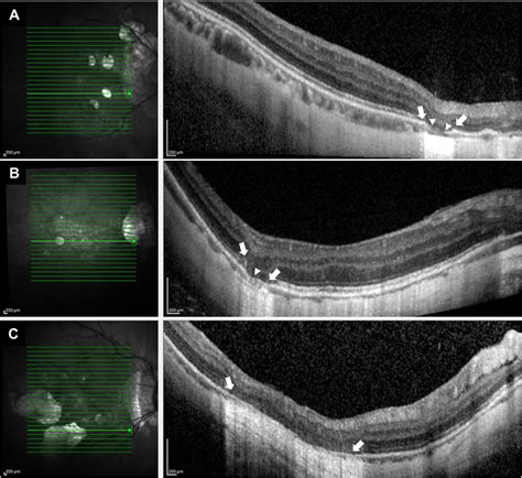 Representative Sdoct Images Of Highly Myopic Eye With Pa A Right