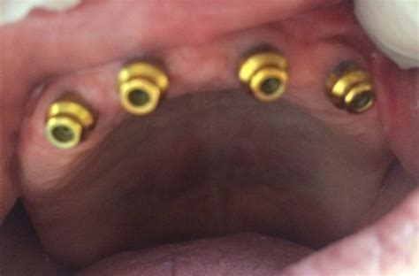 Is Implant For Me Los Altos Dental Excellence Dr Nguyen