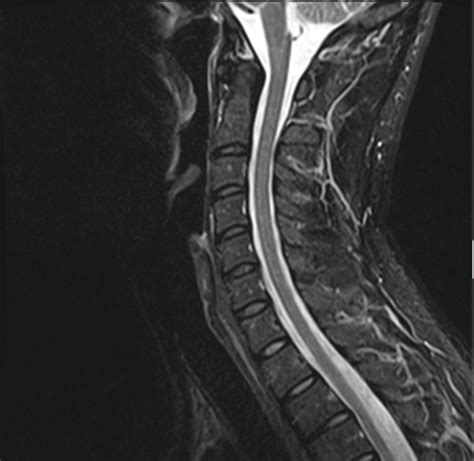 Normal Images Of Spine Joshua Li Md Phd