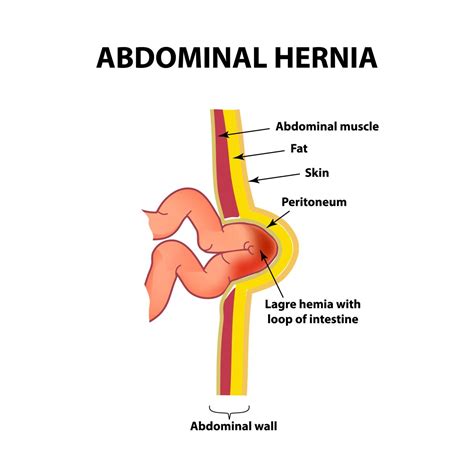 Hernias Complicadas Hernia Center Cdmx