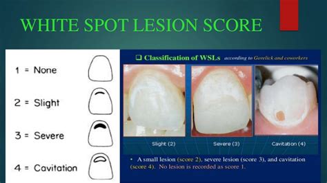 Control Of White Spot Lesions Using Fluoride Varnish In Orthodontic T