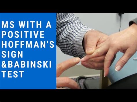 Hoffmann's reflex (hoffmann's sign, sometimes simply hoffmann's, also finger flexor reflex) is a neurological examination finding elicited by a reflex test which can help verify the presence or absence of issues arising from the corticospinal tract. Babinski's Reflex | FunnyCat.TV
