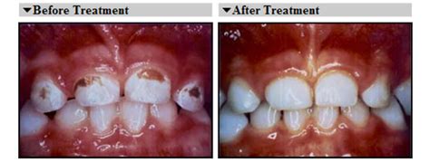 How long should it take to fill a cavity. KIDS FILLING IN JAIPUR - Jaipur Smiles Dental | Dental ...