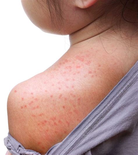 Heat Rash In Kids Causes Symptoms And Treatment 59 Off