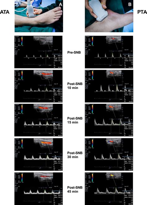 Pulsed Wave Doppler Pwd Ultrasound Of The Anterior Tibial Artery