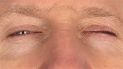 Excessive Eye Blinking Causes Signs And Treatment Healthpulls