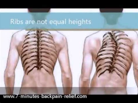 How To Treat Scoliosis 