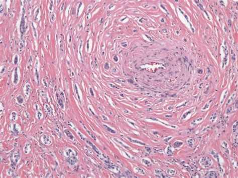 Clear cell variant of mucoepidermoid carcinoma of the salivary glands is rare. Pathology Outlines - Sclerosing mucoepidermoid carcinoma ...