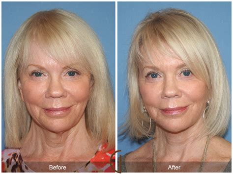 Before And After Facelift 1 Orange County Facial Plastic
