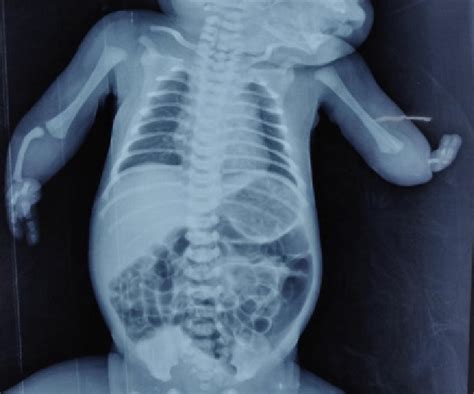 X Ray Image Of The Child With Congenital Upper Limb Deficiency