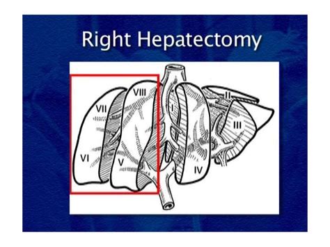 Right Hepatectomy Step By Step Description For Surgeon