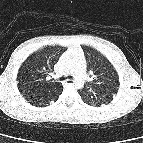 Non Contrast Low Dose Chest Ct Protocol Showing Multiple Subpleural