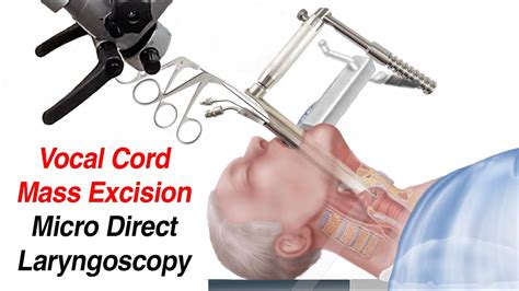 Vocal Cord Surgery Mass Excision Micro Direct Laryngoscopy Youtube