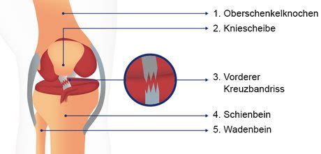 Knieschmerzen können vorne, hinten, außen oder innen am knie auftreten. Kreuzbandriss: Ursachen | Knieschmerzen.behandeln.de